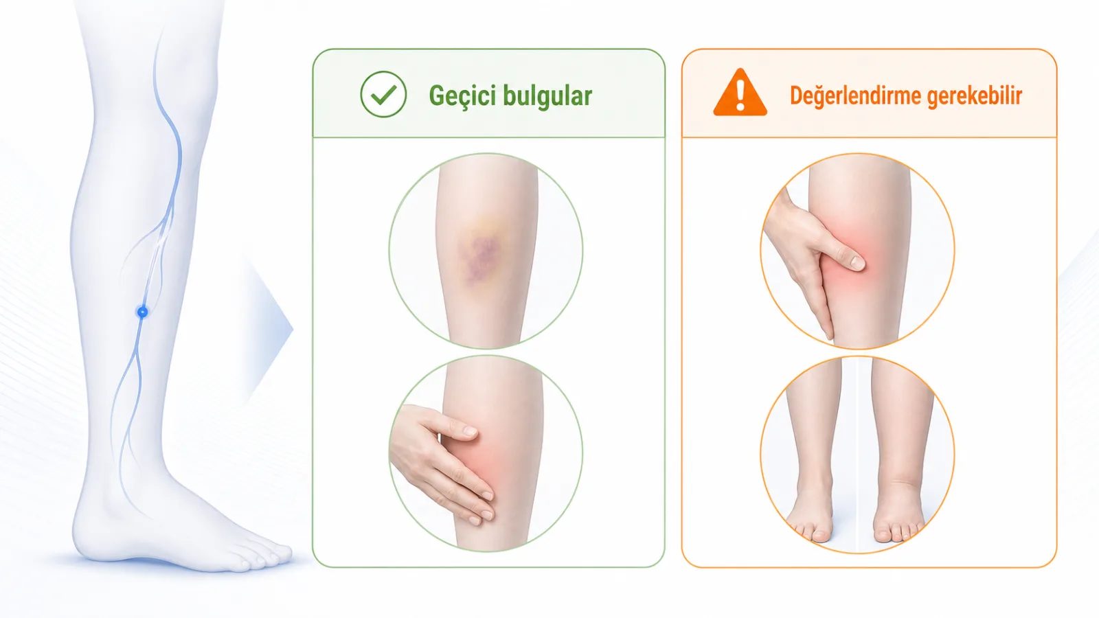 Köpük skleroterapi sonrası geçici morarma ile değerlendirme gerektiren ağrı ve şişlik bulgularını ayıran eğitim görseli