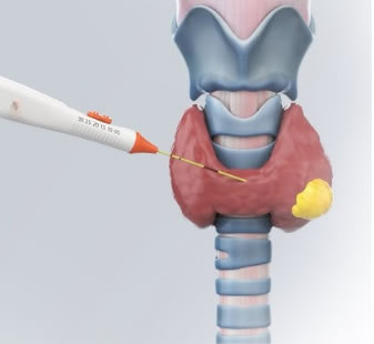 tiroid ablasayon tiroid nodül ablasyonu