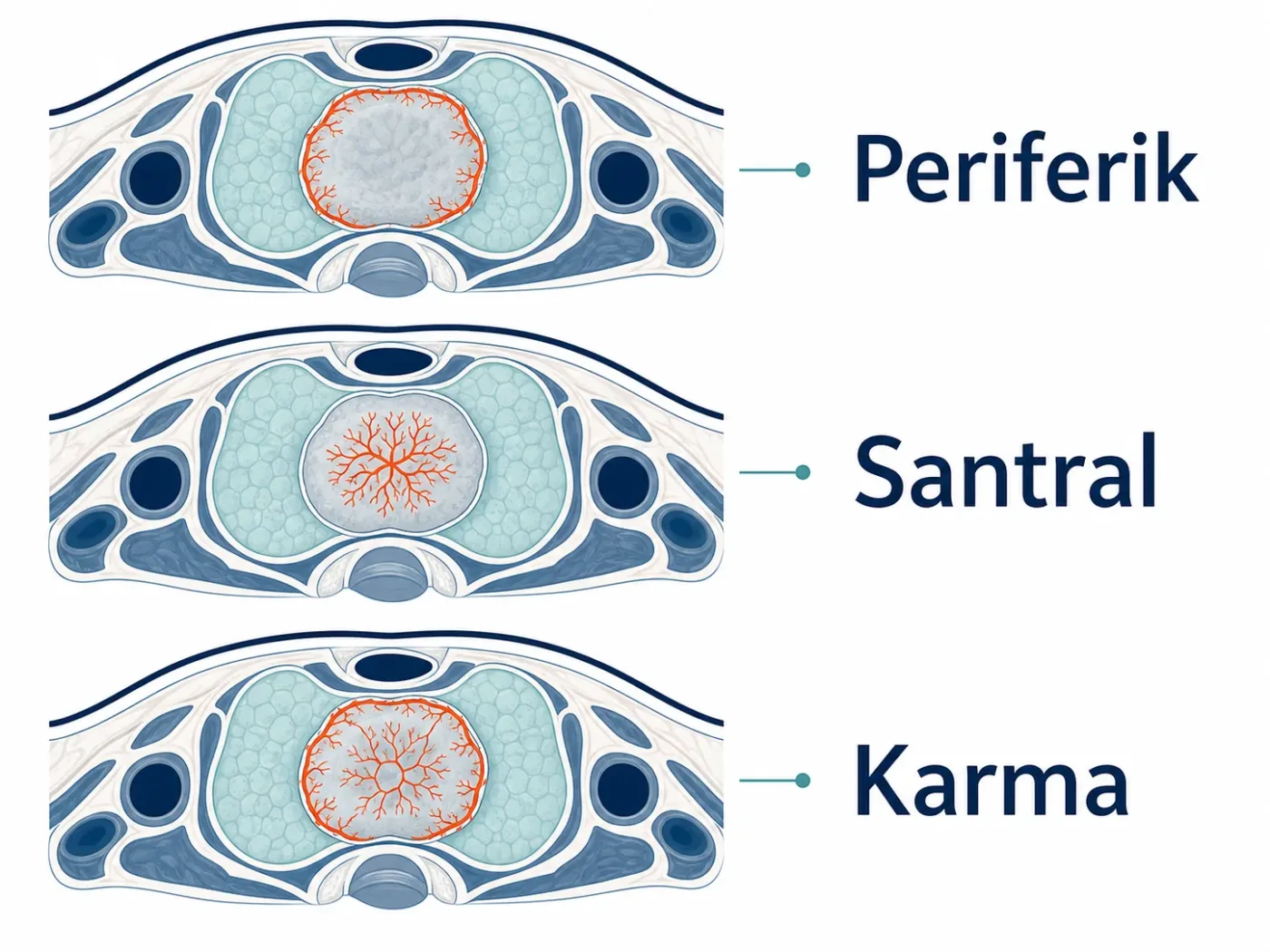 Periferik, santral ve karma kanlanma paternlerini gösteren şematik tiroid nodülü çizimi
