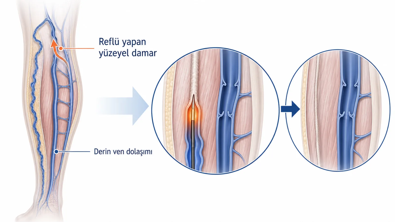 Bacak toplardamarlarının sade anatomik çiziminde reflü yapan yüzeyel damar ve derin ven dolaşımı ayrımı