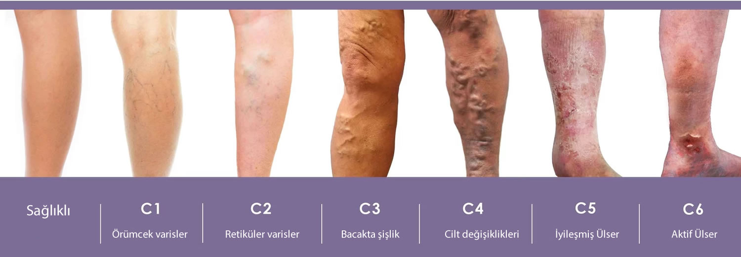 kronik venöz yetmezlik dereceleri