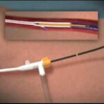 varis rf tedavi ameliyatsız rf varis tedavisi