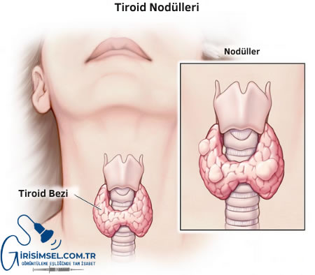 Tiroid Nodülü