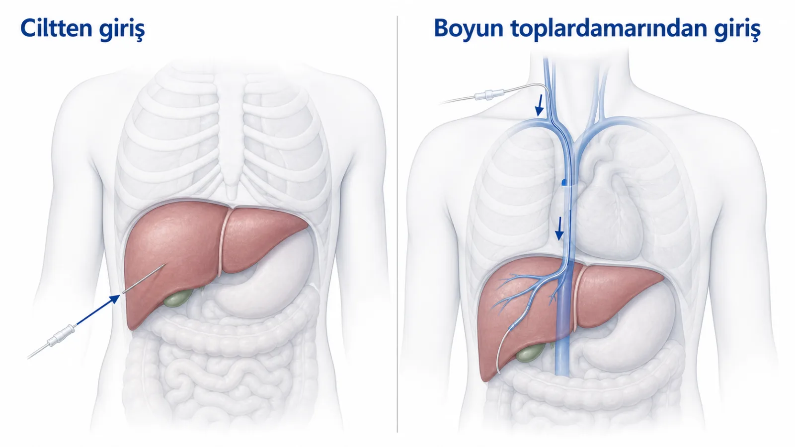 Ciltten perkütan iğne yolu ile boyun toplardamarından transjuguler kateter yolunu karşılaştıran anatomik şema