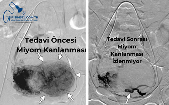 miyom embolizasyon anjiyo görüntüsü