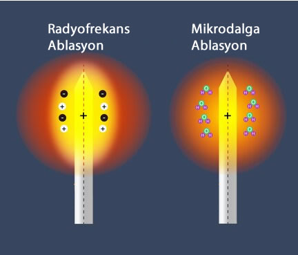 radyofrekans-mikrodalga-ablasyon farkı