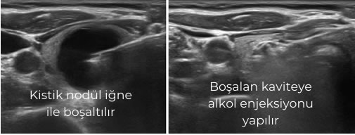 tiroid alkol ablasyonu