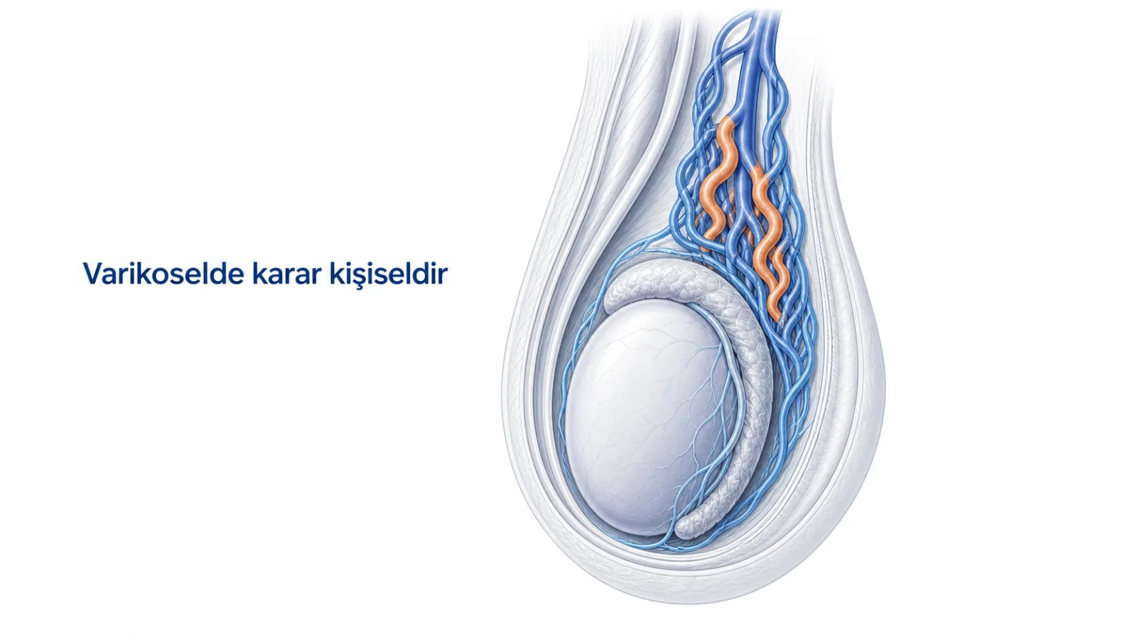 Varikosel ve tedavi kararını gösteren testis toplardamarı illüstrasyonu