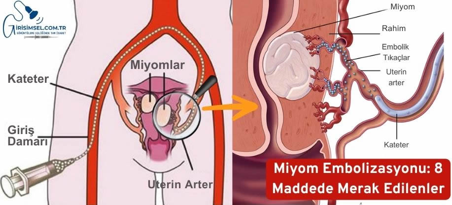 Miyom Embolizasyonu Hakkında Merak Edilenler