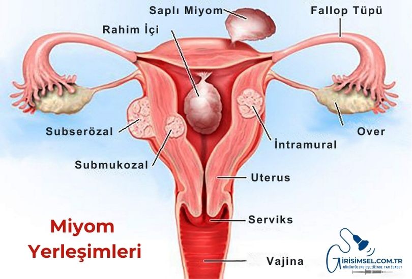 intramural miyom