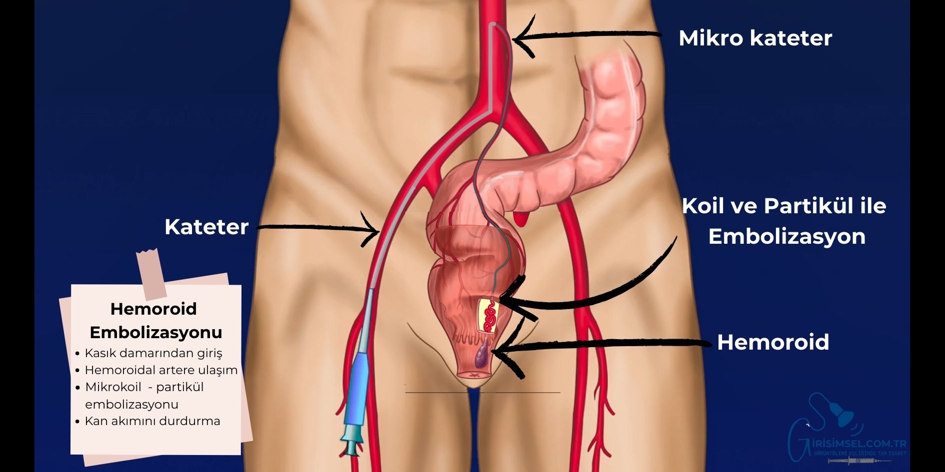 Hemoroid-Embolizasyonu-Basur- Anjiyo ile Ameliyatsiz-Tedavi