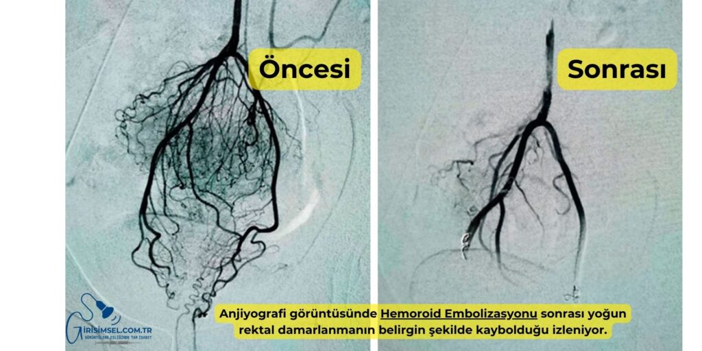 Hemoroid Embolizasyonu Anjiyografi Öncesi-Sonrası