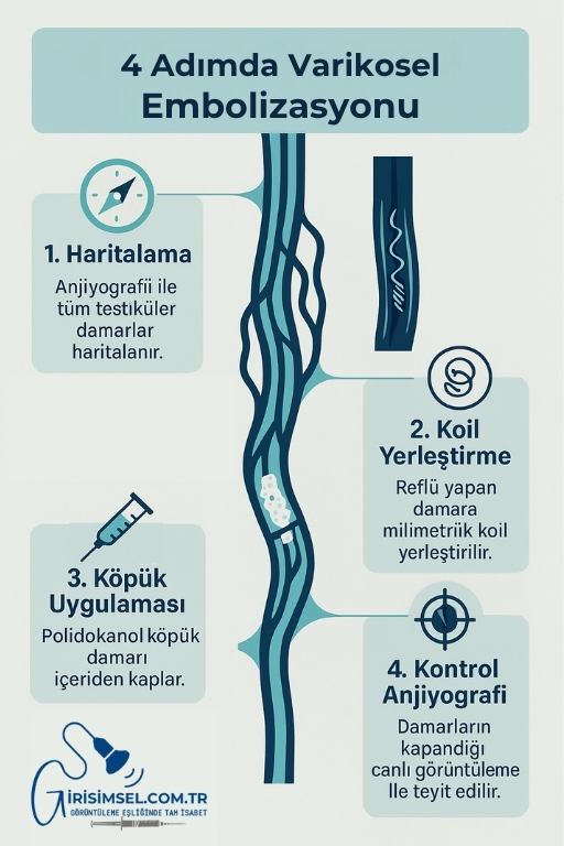 adım adım varikosel embolizasyonu