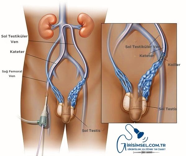 varikosel embolizasyonu