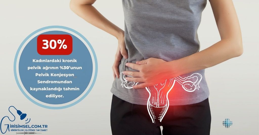 kronik pelvik agri pelvik konjesyon sendromu ve varisler