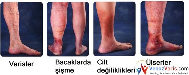 varis belirtileri