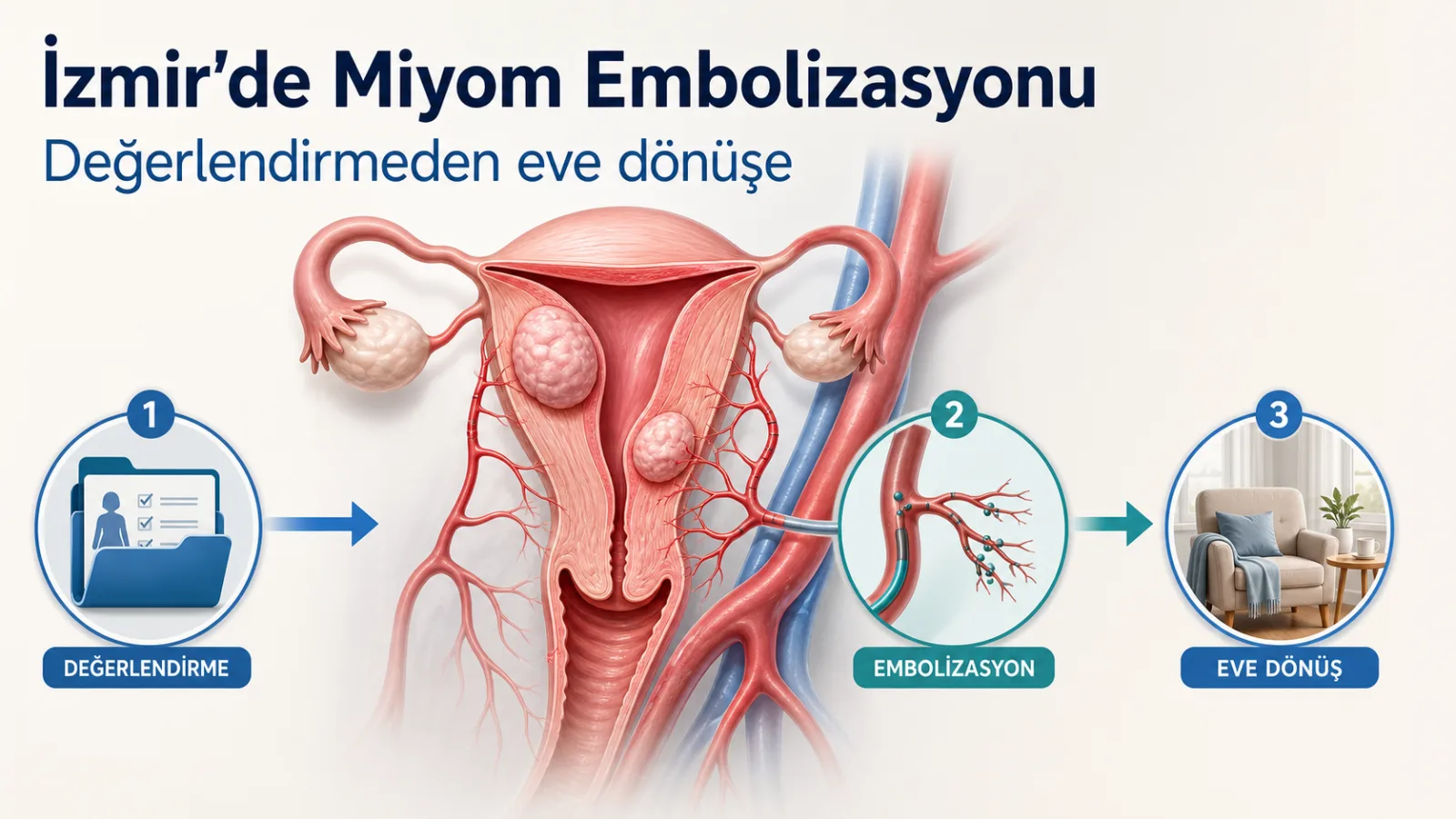 İzmir’de miyom embolizasyonunda değerlendirme, damar yoluyla tedavi ve eve dönüş aşamalarını gösteren rahim ve miyom çizimi