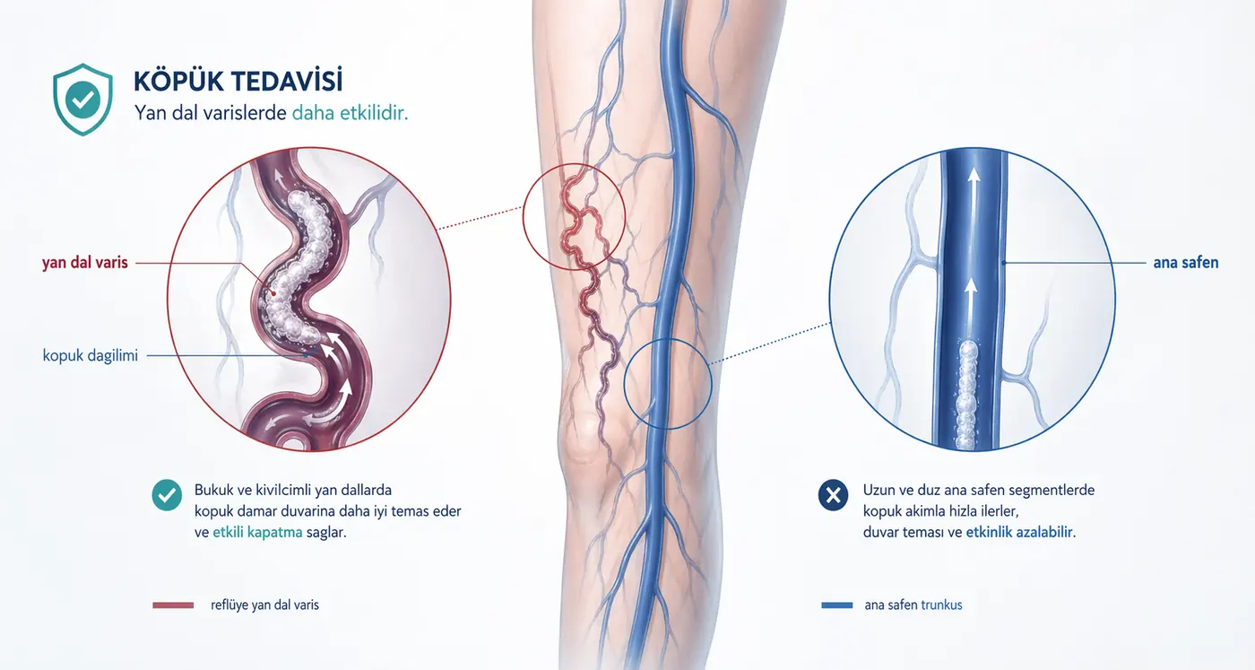 Köpük Tedavisi Hangi Varislerde Daha Etkilidir? icin mekanizmayi anlatan sematik gorsel