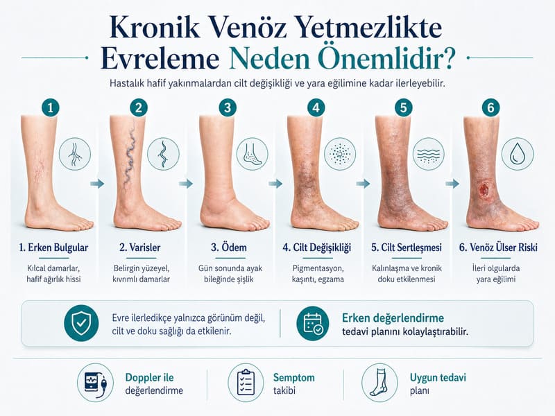 venöz yetmezlik evteleri grade