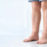 Bacakta Şişlik ve Ödem Varis Belirtisi Olabilir mi? – hero gorseli Bacakta Şişlik ve Ödem Varis Belirtisi Olabilir mi? konusunu tanitan hero gorsel