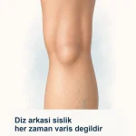 Diz arkasinda lokal sislik ve alt baldirda hafif yuzeyel varis izlenimini birlikte gosteren aciklayici gorsel.
