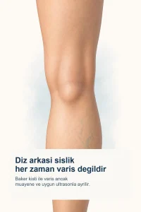 Diz arkasinda lokal sislik ve alt baldirda hafif yuzeyel varis izlenimini birlikte gosteren aciklayici gorsel.
