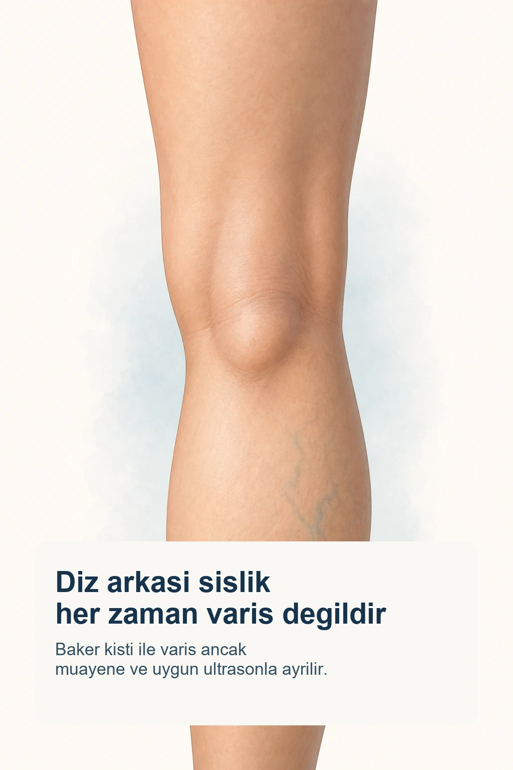 Diz arkasinda lokal sislik ve alt baldirda hafif yuzeyel varis izlenimini birlikte gosteren aciklayici gorsel.