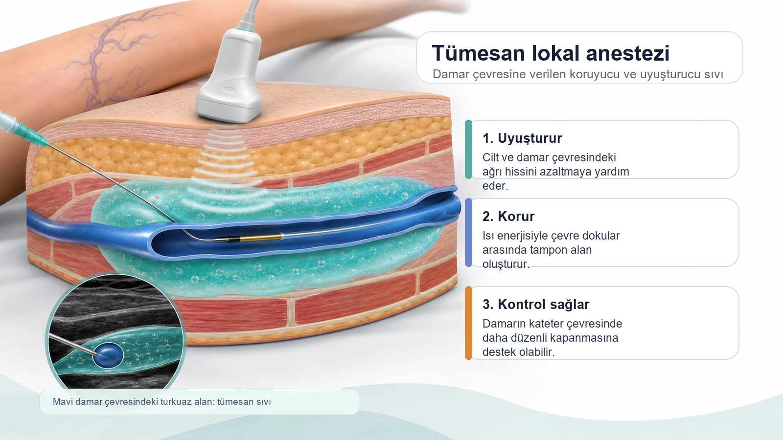 Tümesan lokal anestezinin uyuşturma, koruma ve damar çevresinde tampon etkisini gösteren açıklamalı görsel