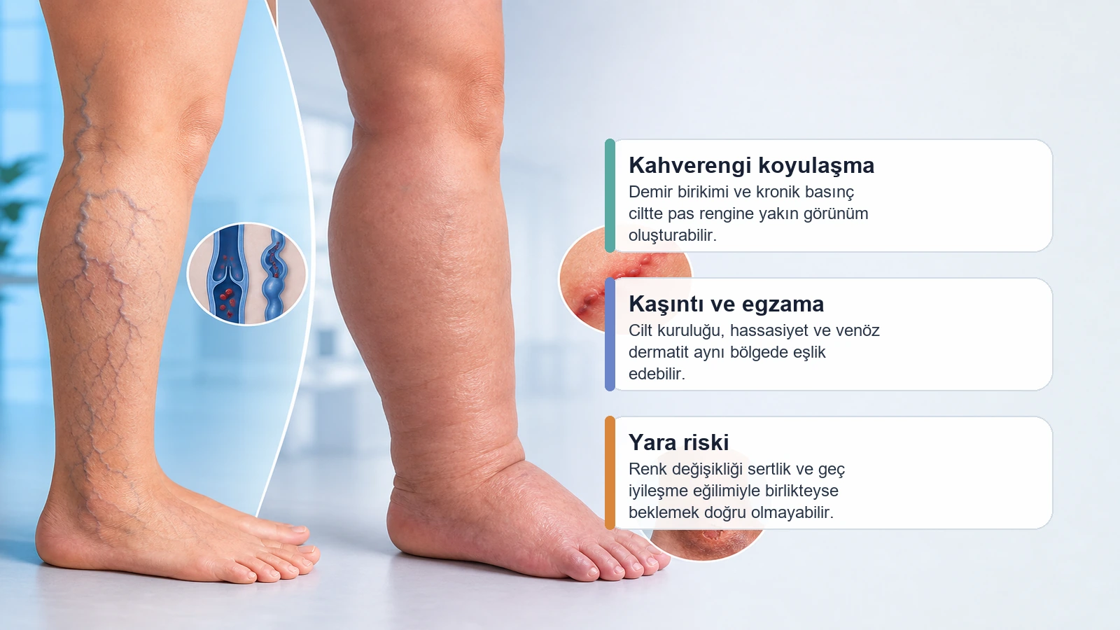 Variste kahverengi koyulaşma, kaşıntı ve yara eğilimini birlikte anlatan premium medikal görsel