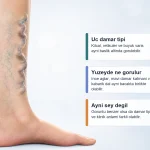 Varisli Bacak Goruntusu: Kilcal, Retikuler ve Buyuk Varisler Nasil Ayirt Edilir? – Premium kilcal damar hero Varisli Bacak Goruntusu: Kilcal, Retikuler ve Buyuk Varisler Nasil Ayirt Edilir? için bacakta ince mor-kirmizi damar aglarinin neden daha gorunur hale geldigini açıklayan premium medikal görsel